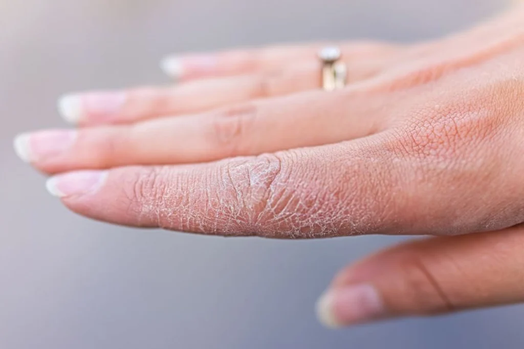 4 componentes essenciais para prevenir e tratar mãos ressecadas