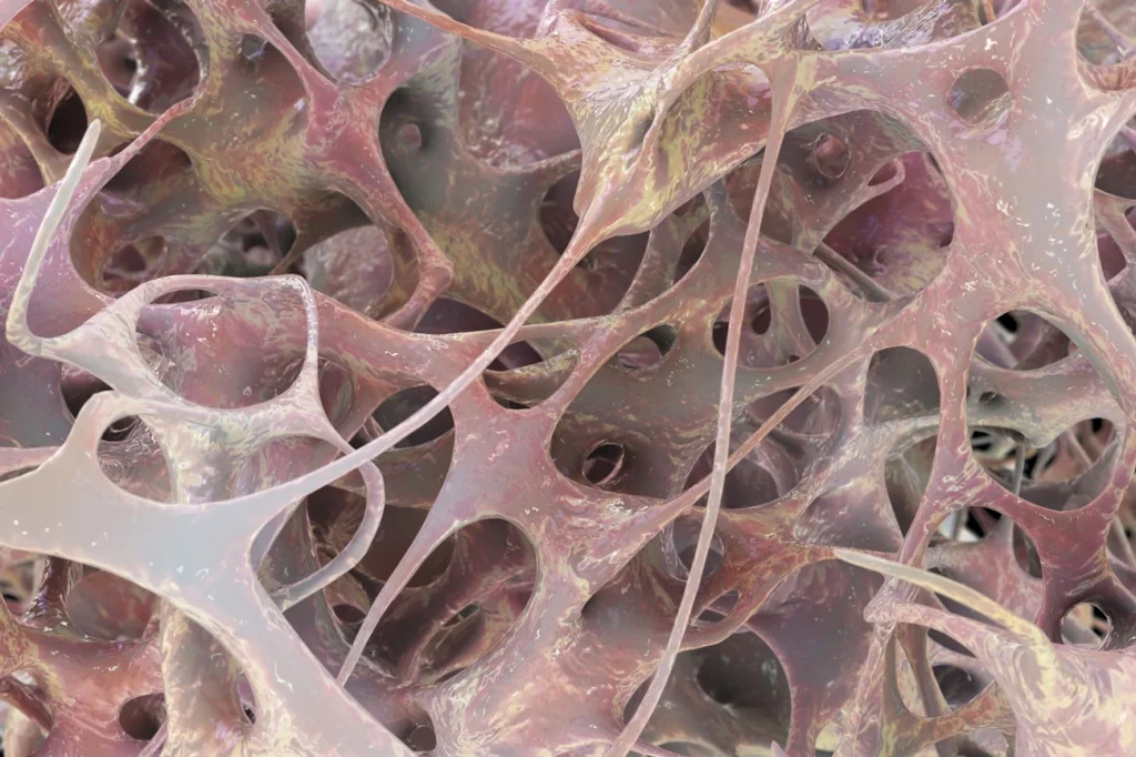 Descubra 5 Sintomas da Osteoporose e Previna Fraturas Agora com Dicas de Ortopedista e Fisiatra